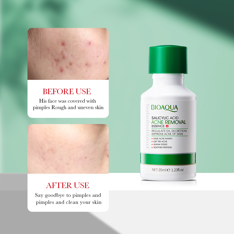 BIOAOUA – Essence d'éliminatio - Salicylic Acid Blackhead Remover avis et prix