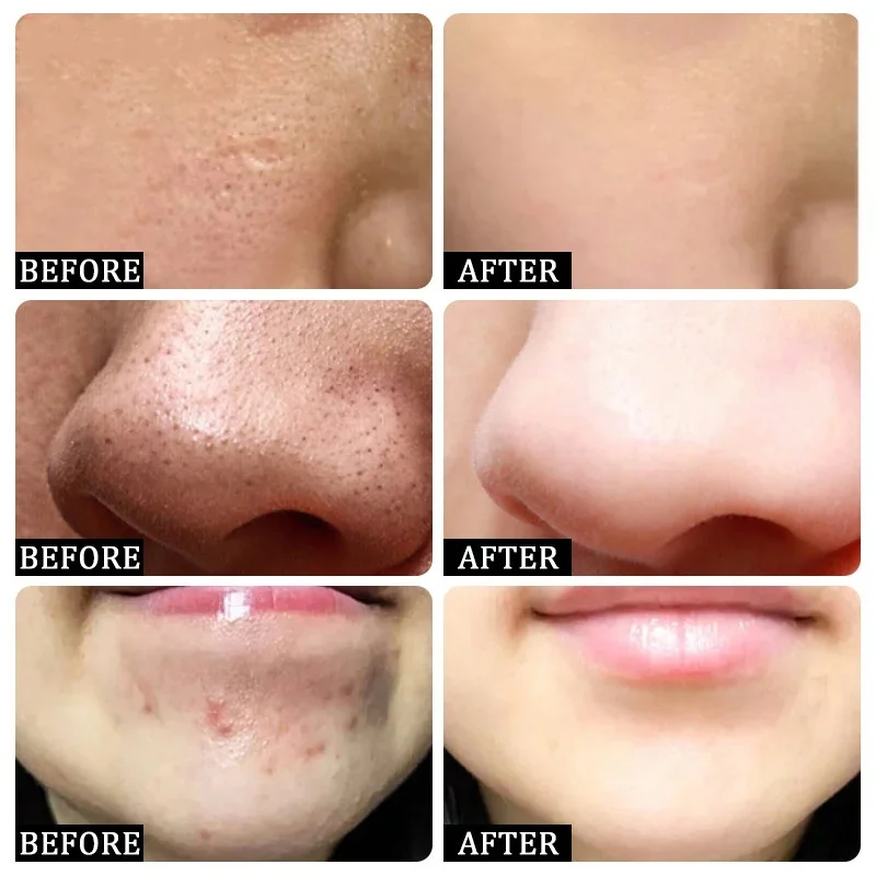Crème de nettoyage des pores à - Salicylic Acid Blackhead Remover avis et prix