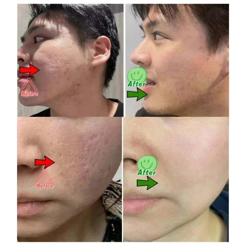 Crème de nettoyage des pores à - Salicylic Acid Blackhead Remover avis et prix