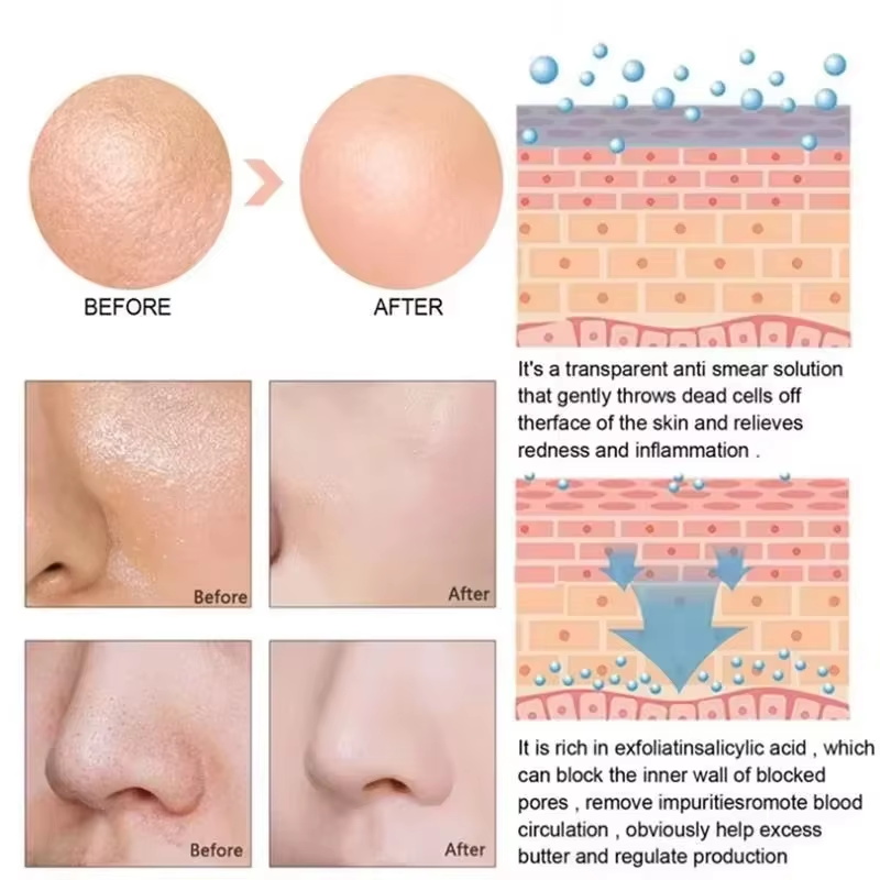 Sérum Réducteur de Pores à l'A - Salicylic Acid Blackhead Remover avis et prix